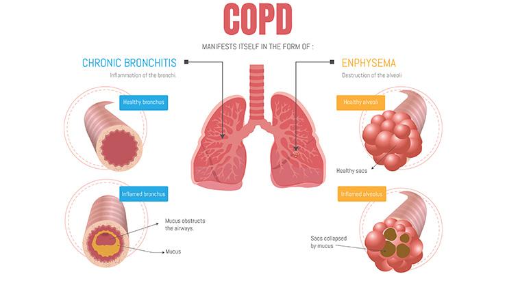 COPD Study